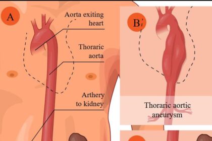 Everything you need to know: Aneurysms
