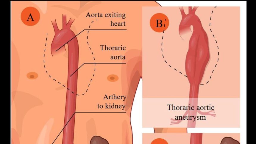 Everything you need to know: Aneurysms