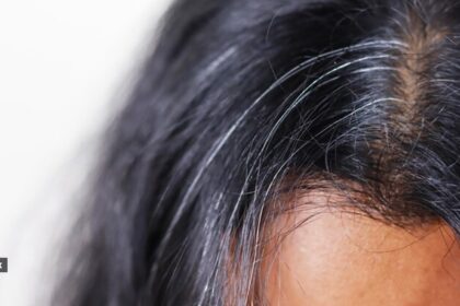Grey hair results from the depletion of melanocytes, the cells responsible for producing melanin