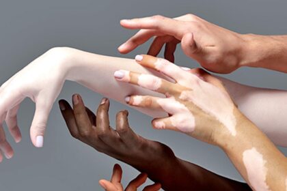 Skin Healthless Health: A Global Call to End Skin Bleaching and Prioritization