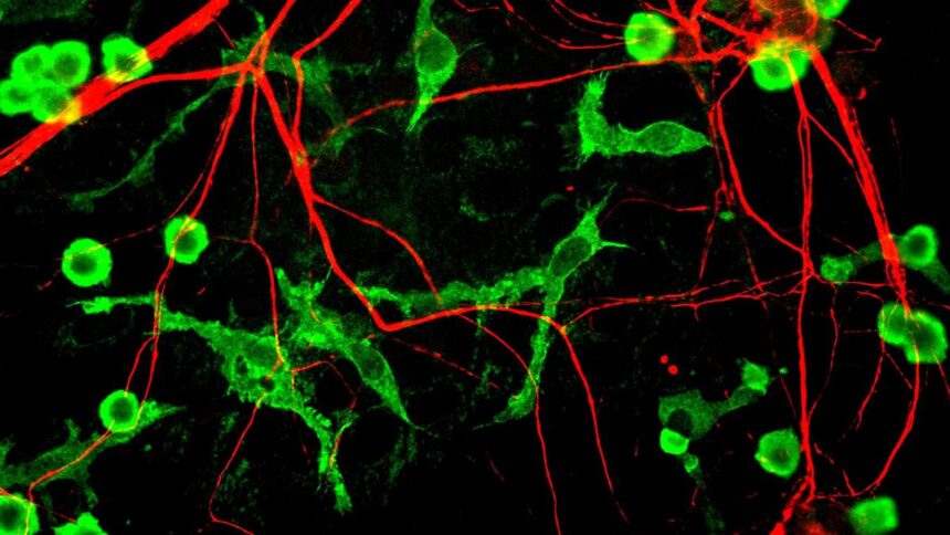 Immune Cell Fat Blocks the Brain's Ability to Clean Alzheimer's Disease Plaque