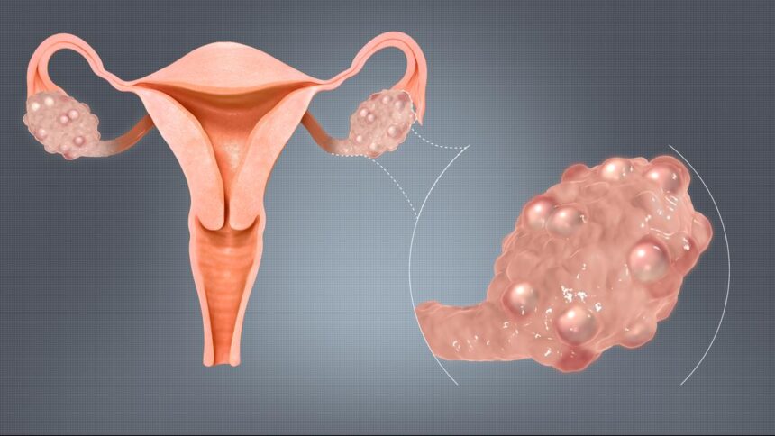 How genetic factors influence the onset and progression of polycystic ovarian syndrome