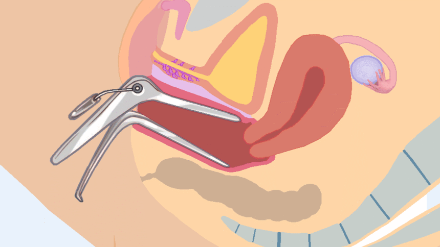 Researchers redesign the speculum to relieve fear and pain