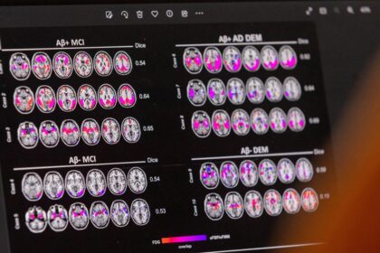 Researchers may reveal signs of Alzheimer's disease before symptoms appear, researchers say