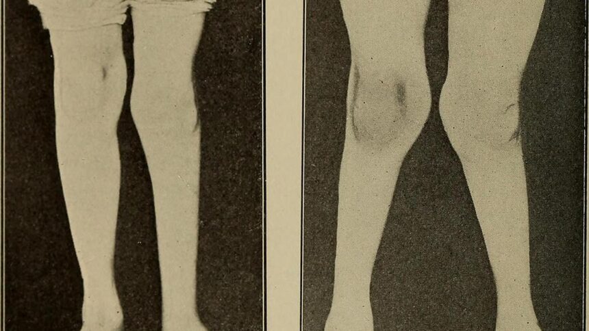 Improvement of pediatric bone health through growth modulation
