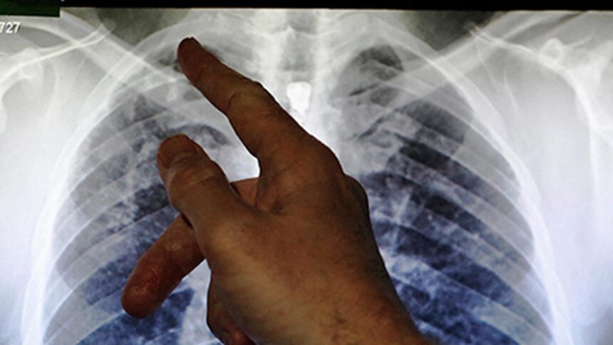 Maharashtra Health Department integrates tuberculosis screening into the medical college's family adoption program
