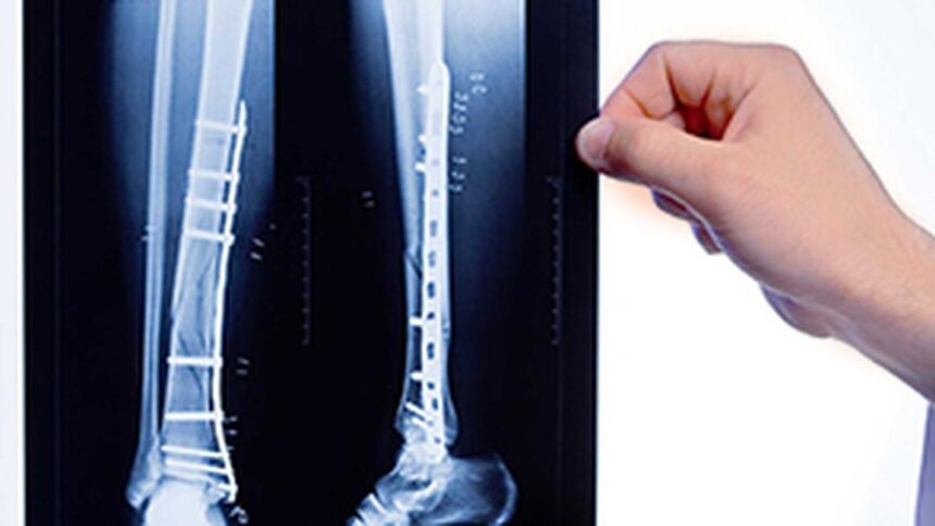Men and Osteoporosis: Arresting the myth that only women are at risk