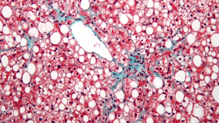 The urgent need to fight the fatty liver epidemic in India