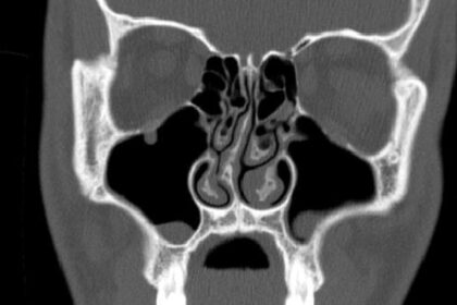 Deviant septum: A curved nasal wall is more common than you think, and when do you seek treatment?