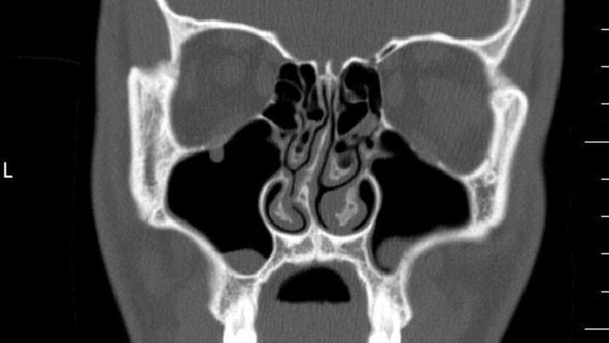 Deviant septum: A curved nasal wall is more common than you think, and when do you seek treatment?