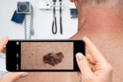 Is your skin app misleading you? Why is it necessary to see a dermatologist?