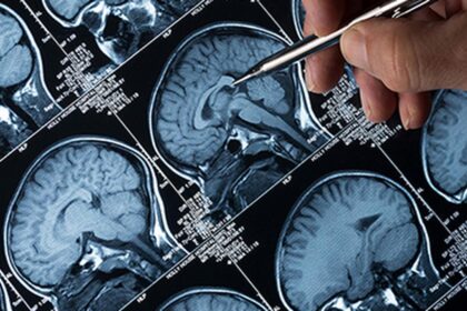 Globally necessary medical reforms to match diagnostic progress, Alzheimer's disease treatment: researchers