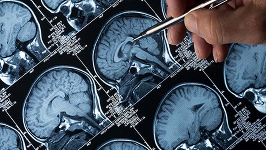 Globally necessary medical reforms to match diagnostic progress, Alzheimer's disease treatment: researchers