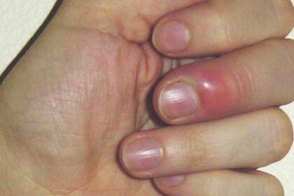 It's not just nail infections