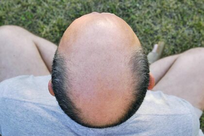 The truth about baldness: The high cost of instant hair care