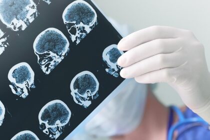 Brain cancer: How much we've been leaning can reverse the year