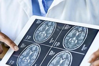 Could a stent in the brain stop a stroke before it happens?