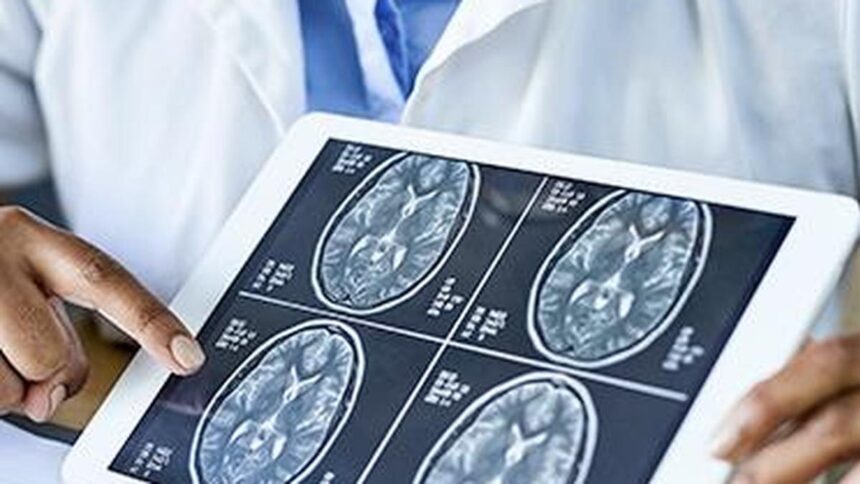 Could a stent in the brain stop a stroke before it happens?