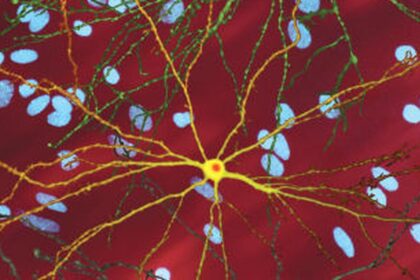 Researchers and families confront Huntington's disease with rhythm and determination