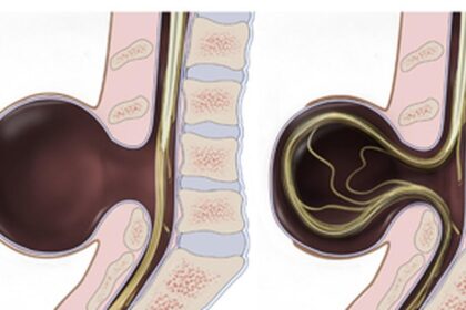 Everything you need to know about spina bifida