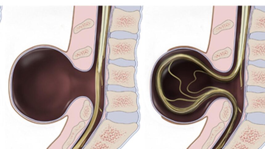 Everything you need to know about spina bifida