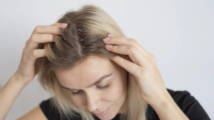 Tired of greasy, sticky dandruff? Here are 6 easy fixes you need
