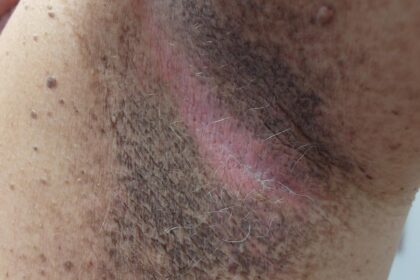 Acanthosis nigricans: skin changes that may indicate diabetes