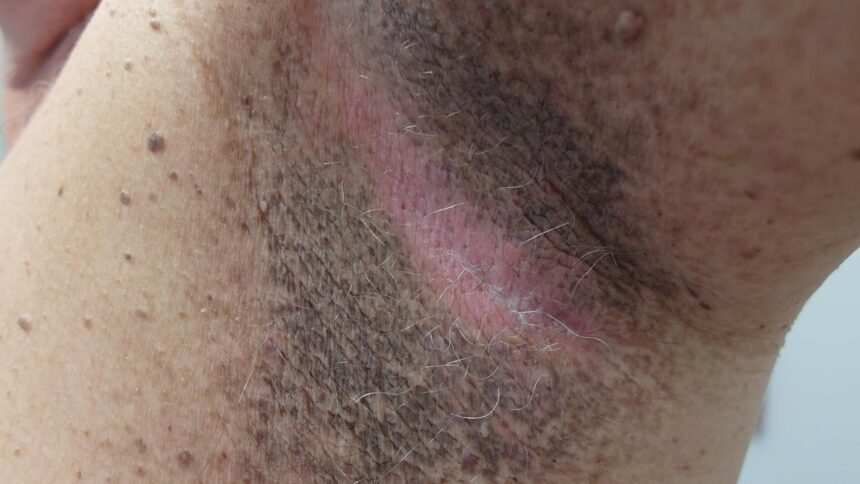 Acanthosis nigricans: skin changes that may indicate diabetes
