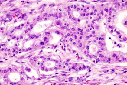 Hypoxia rewires membrane lipids and promotes migration of pancreatic cells: IIT-Bombay study