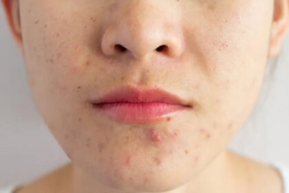 5 skin care hacks to treat acne as the seasons change
