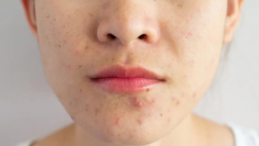 5 skin care hacks to treat acne as the seasons change