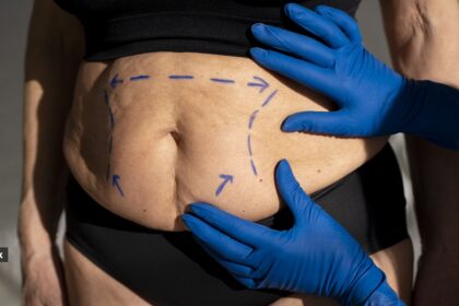 The hidden brain risk after bariatric surgery most people don’t know about