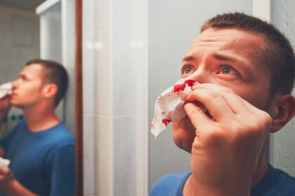 nose bleed