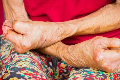 Study investigates migrant-related leprosy transmission in Chennai