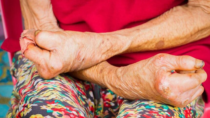 Study investigates migrant-related leprosy transmission in Chennai