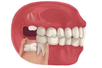 What you need to know: About impacted wisdom teeth
