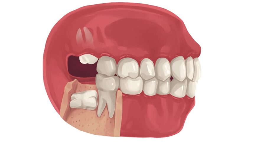 What you need to know: About impacted wisdom teeth
