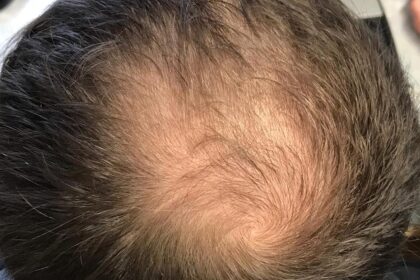 What you need to know: About male pattern baldness