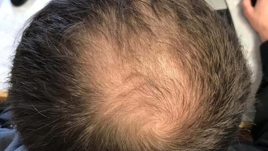 What you need to know: About male pattern baldness