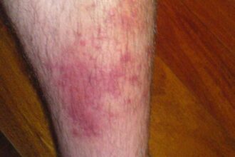 What you need to know: About cellulitis