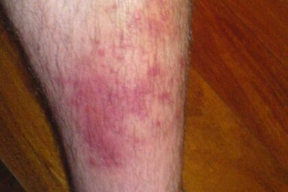 What you need to know: About cellulitis