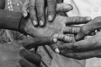 “Why did my son get this disease?”: About prejudice, poverty, and the tough fight against leprosy