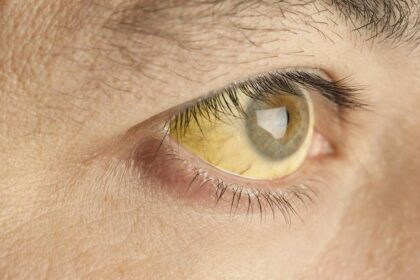 Everything you need to know about hepatitis A