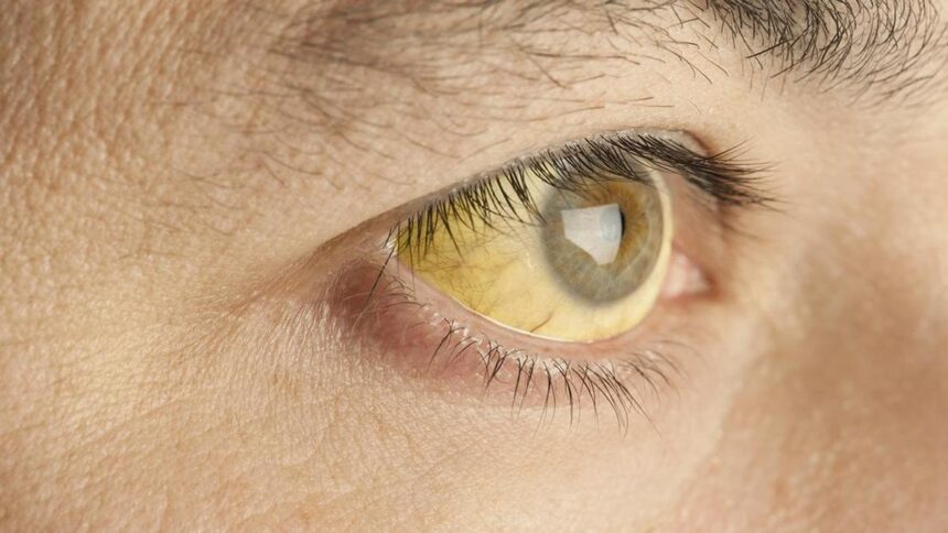 Everything you need to know about hepatitis A