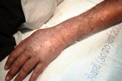 Chronic urticaria requires long-term care, not endless search for triggers: experts
