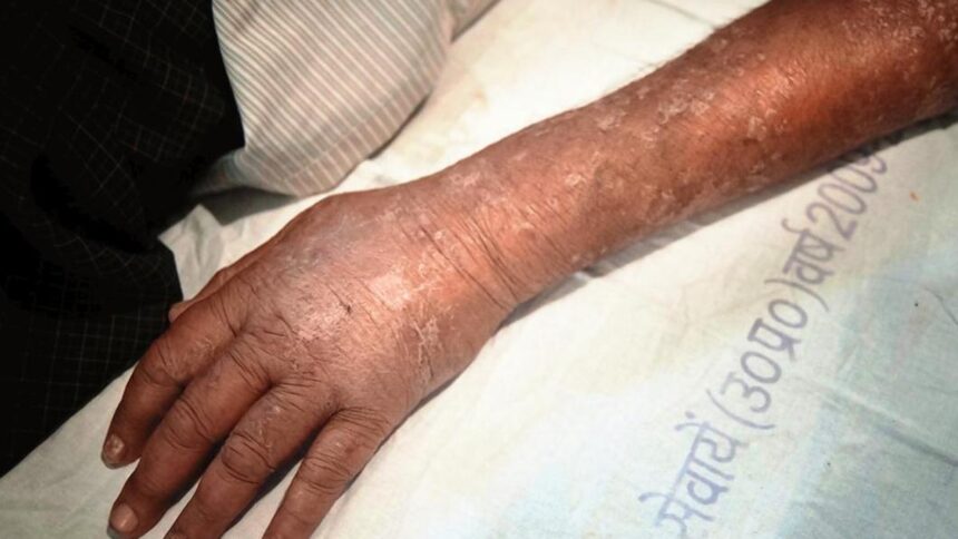 Chronic urticaria requires long-term care, not endless search for triggers: experts