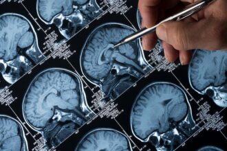 Experts emphasize early diagnosis, long-term care and policy support for people living with epilepsy