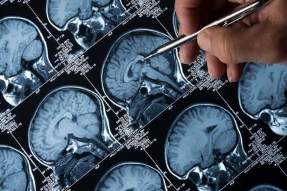 Experts emphasize early diagnosis, long-term care and policy support for people living with epilepsy