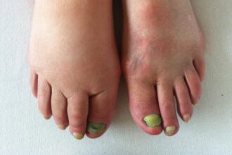 Lymphedema care: from early detection to long-term management