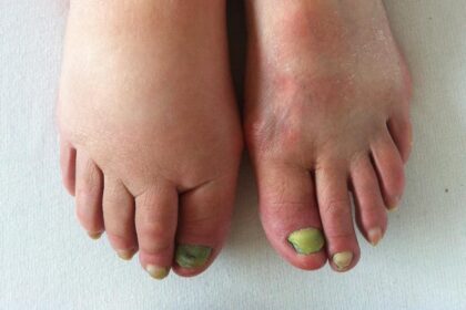 Lymphedema care: from early detection to long-term management